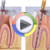 Endodonti Video 3