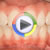 Konservatif Diş Tedavisi Video 3